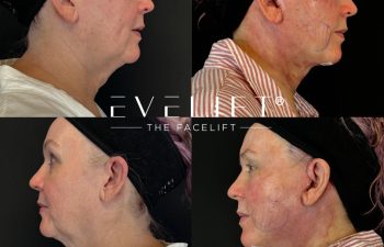 female patient before and after EVELIFT®