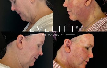 female patient before and after EVELIFT®