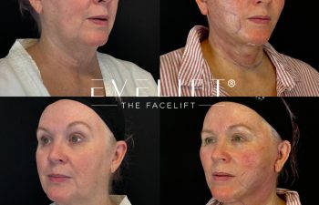 female patient before and after EVELIFT®