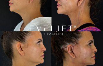 female patient before and after EVELIFT®