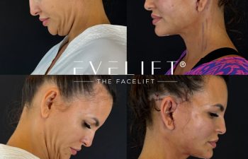 female patient before and after EVELIFT®