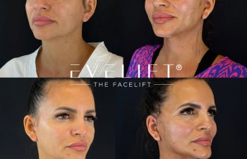 female patient before and after EVELIFT®