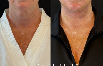female patient before and after EVELIFT®
