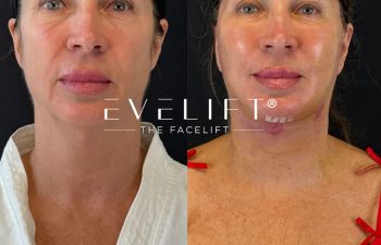 female patient before and after EVELIFT®