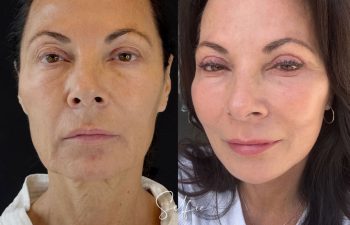 female patient before and after EVELIFT®