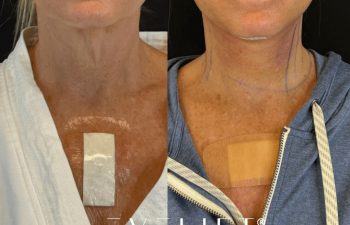 female patient before and after EVELIFT®