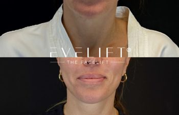 female patient before and after EVELIFT®