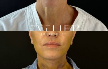 female patient before and after EVELIFT®