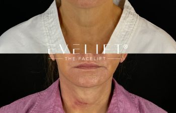 female patient before and after EVELIFT®
