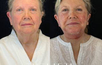female patient before and after EVELIFT®