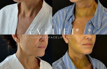 female patient before and after EVELIFT®