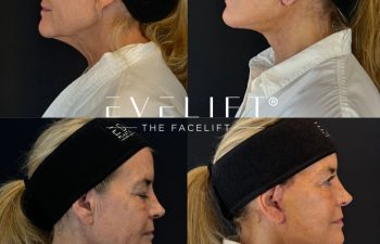 female patient before and after EVELIFT®