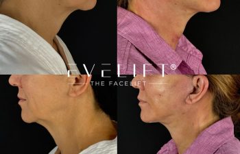 female patient before and after EVELIFT®