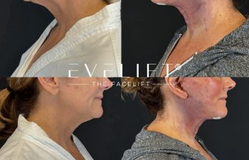 female patient before and after EVELIFT®