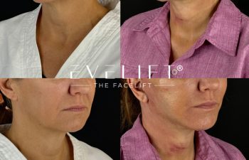 female patient before and after EVELIFT®