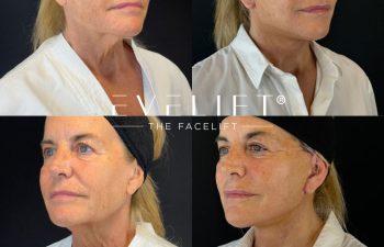 female patient before and after EVELIFT®