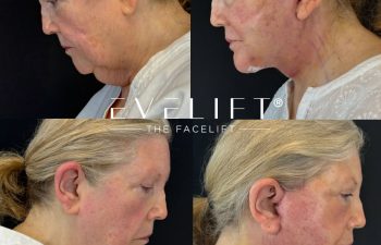 female patient before and after EVELIFT®