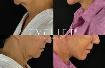 female patient before and after EVELIFT®