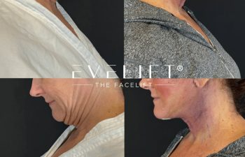 female patient before and after EVELIFT®