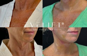 female patient before and after EVELIFT®