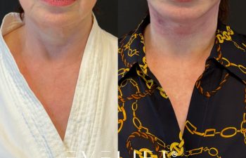 female patient before and after EVELIFT®
