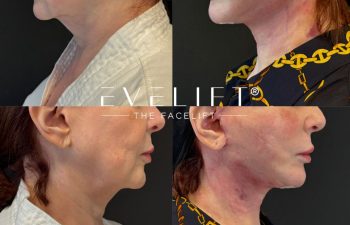 female patient before and after EVELIFT®