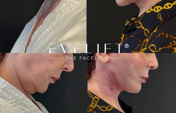 female patient before and after EVELIFT®