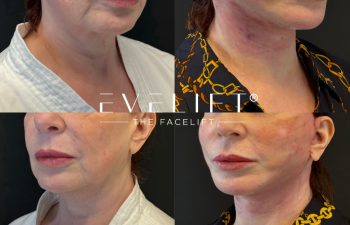 female patient before and after EVELIFT®