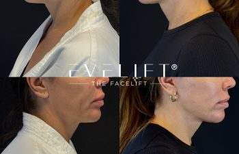 female patient before and after EVELIFT®