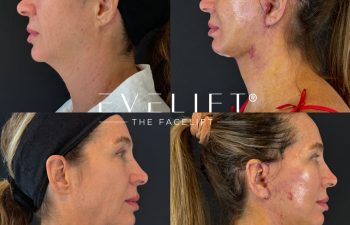 female patient before and after EVELIFT®