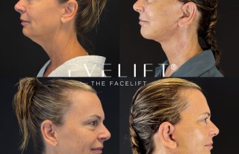 female patient before and after EVELIFT®