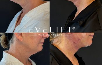 female patient before and after EVELIFT®