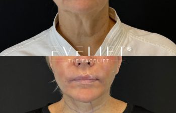 female patient before and after EVELIFT®