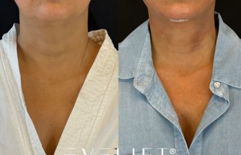 female patient before and after EVELIFT®