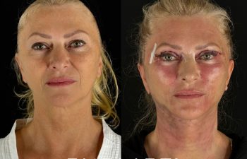 female patient before and after EVELIFT®
