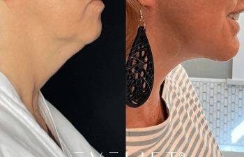 female patient before and after EVELIFT®