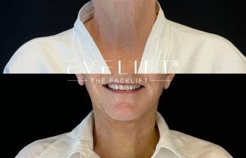 female patient before and after EVELIFT®