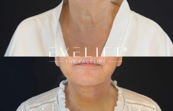 female patient before and after EVELIFT®