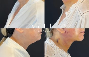 female patient before and after EVELIFT®