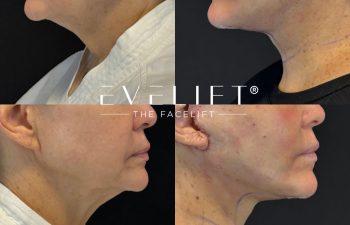 female patient before and after EVELIFT®