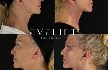 female patient before and after EVELIFT®