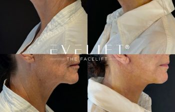 female patient before and after EVELIFT®