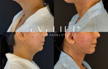 female patient before and after EVELIFT®