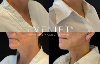 female patient before and after EVELIFT®