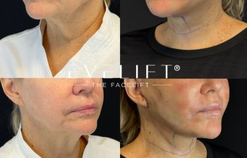 female patient before and after EVELIFT®