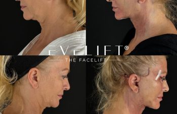 female patient before and after EVELIFT®
