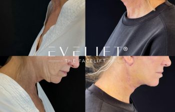 female patient before and after EVELIFT®