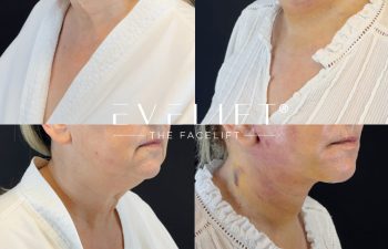 female patient before and after EVELIFT®