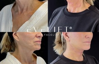 female patient before and after EVELIFT®