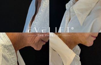female patient before and after EVELIFT®